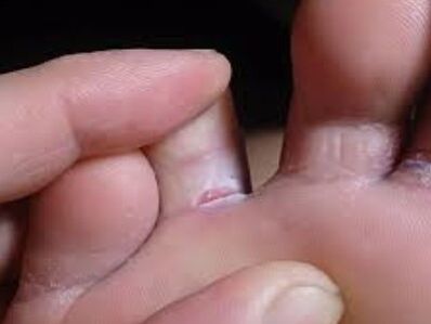 Toe fungus