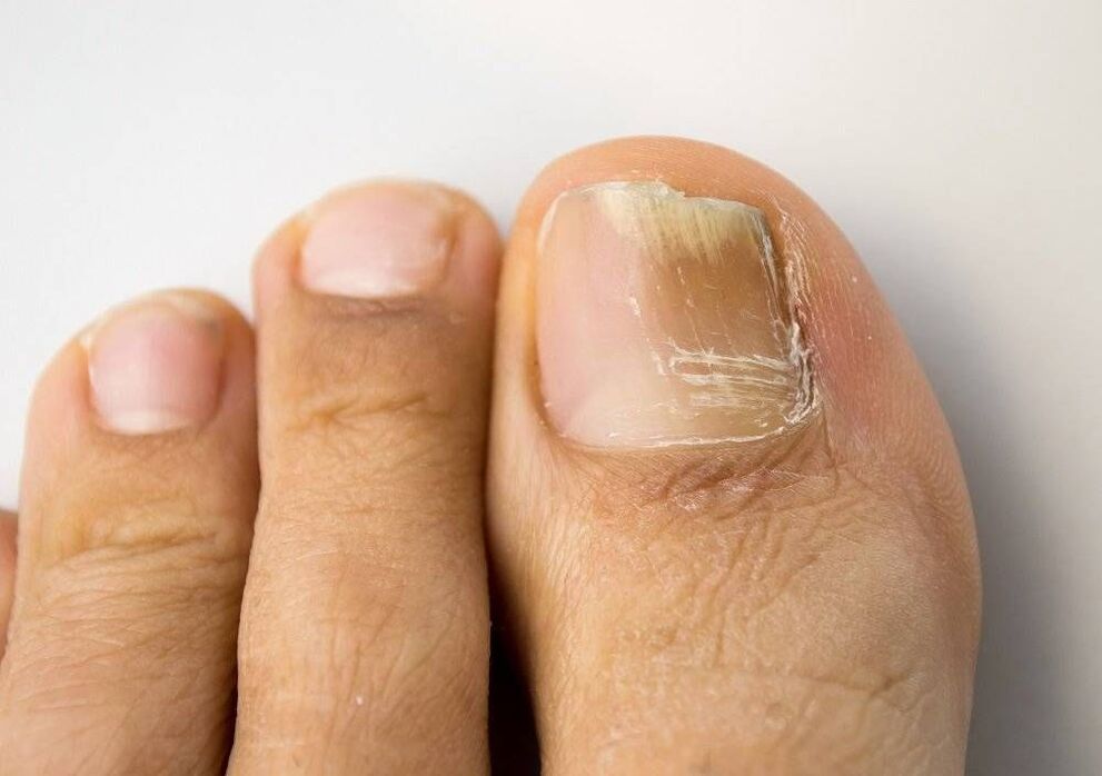 Types of fungal infections in the big toe