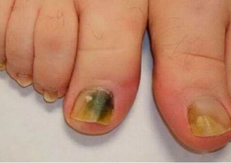 Infections affect the foundations