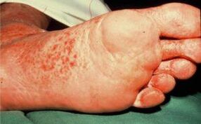Mushrooms on the feet with ulcers