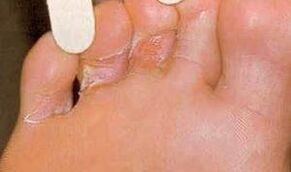 Skin damage to Mycosis