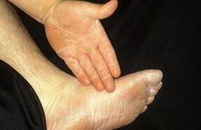 The removal form of mycosis is manifested by peeling