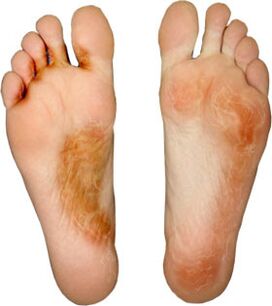 Cure fungus on your fingers and not pick it up