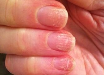 The initial phase of mushrooms on nails
