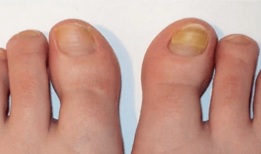 The initial phase of the nail mushroom