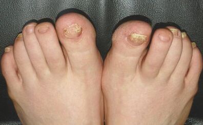 Mushroom signs on the nail