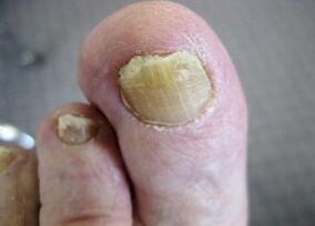 The cause of the appearance of mushrooms on the nail