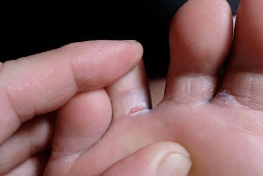 The appearance of bubble formation on the foot