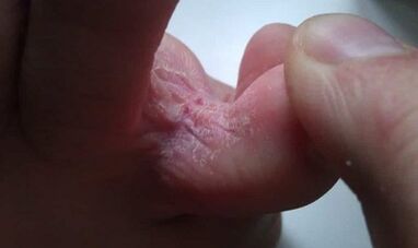 The stages of mushroom growth between the toes