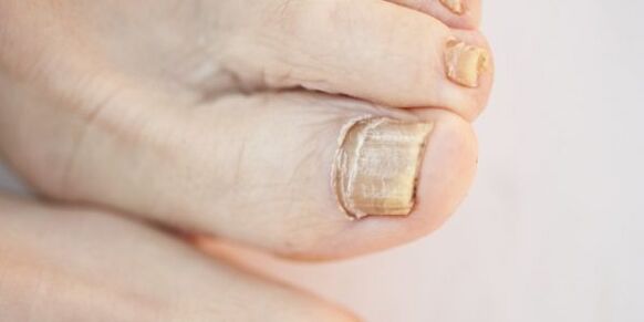 Damage to the nail plates of the toes due to fungus