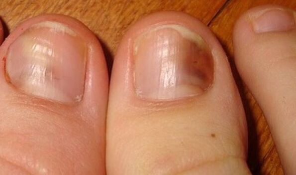 Nails affected by fungus