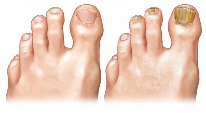 healthy fingernails and toenail fungus