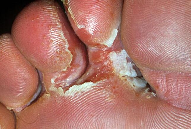 Symptoms of interdigital thrush