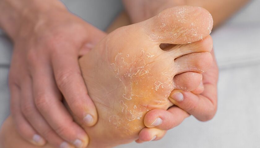 Peeling and itching are symptoms of athlete's foot