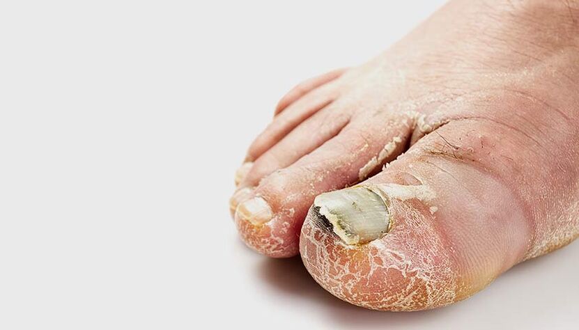 Signs of exudative-dyshidrotic athlete's foot