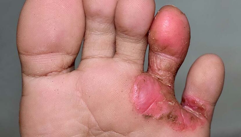 Symptoms of toe fungus