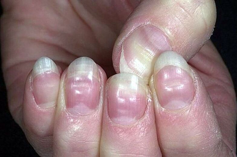 Leukocytes on nails