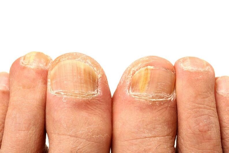 Onychomycosis on nails