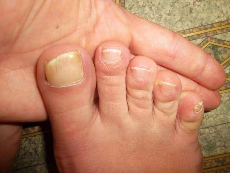 Toenail fungus disease