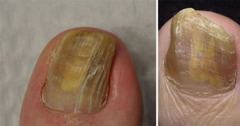 nail dystrophy