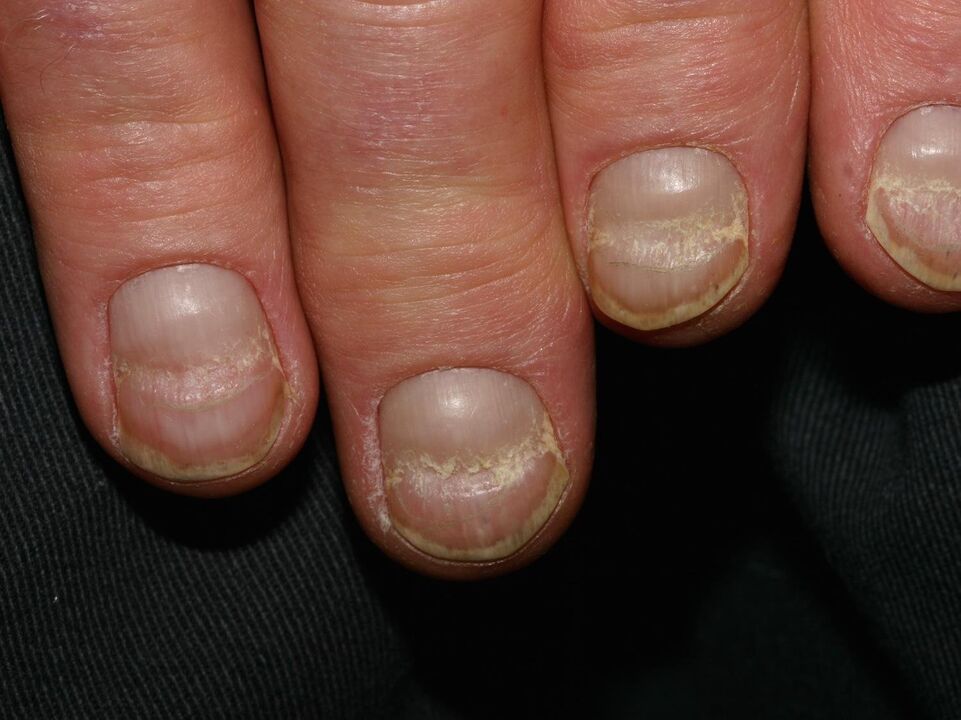 nail fungus