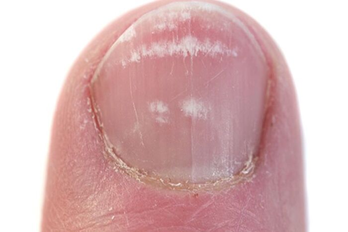 Signs of fungus on nails